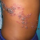 Illustration for article titled obat herpes zoster